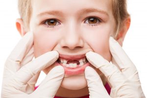 La caída de los dientes en los niños
